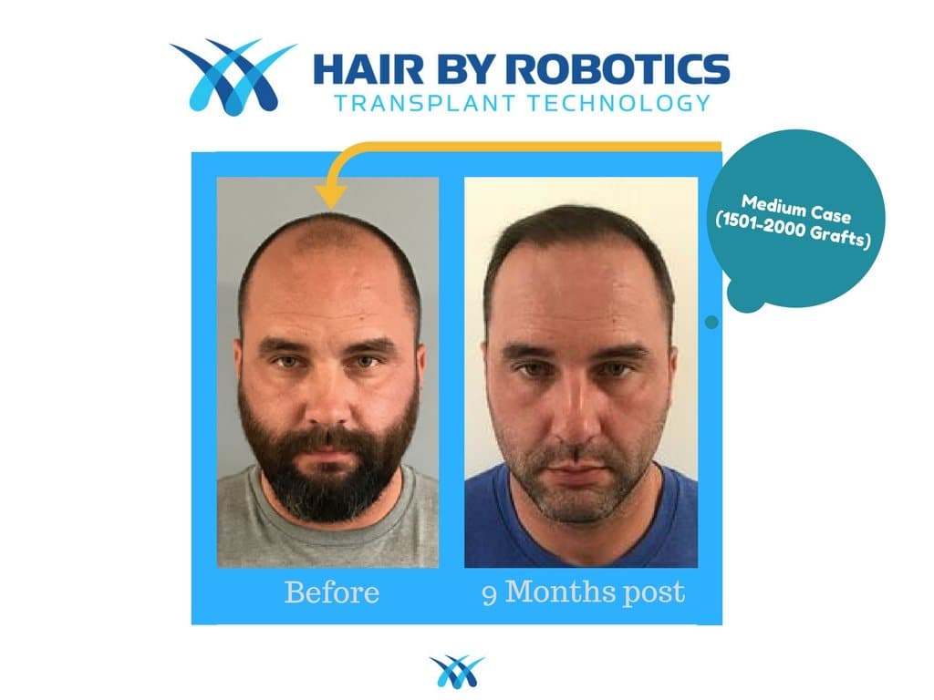 Before and nine-months-post hair restoration result for a medium graft case