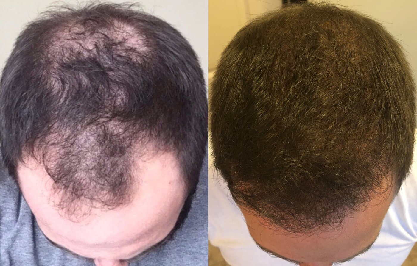 Before and after crown density restoration for a 2,700 graft case