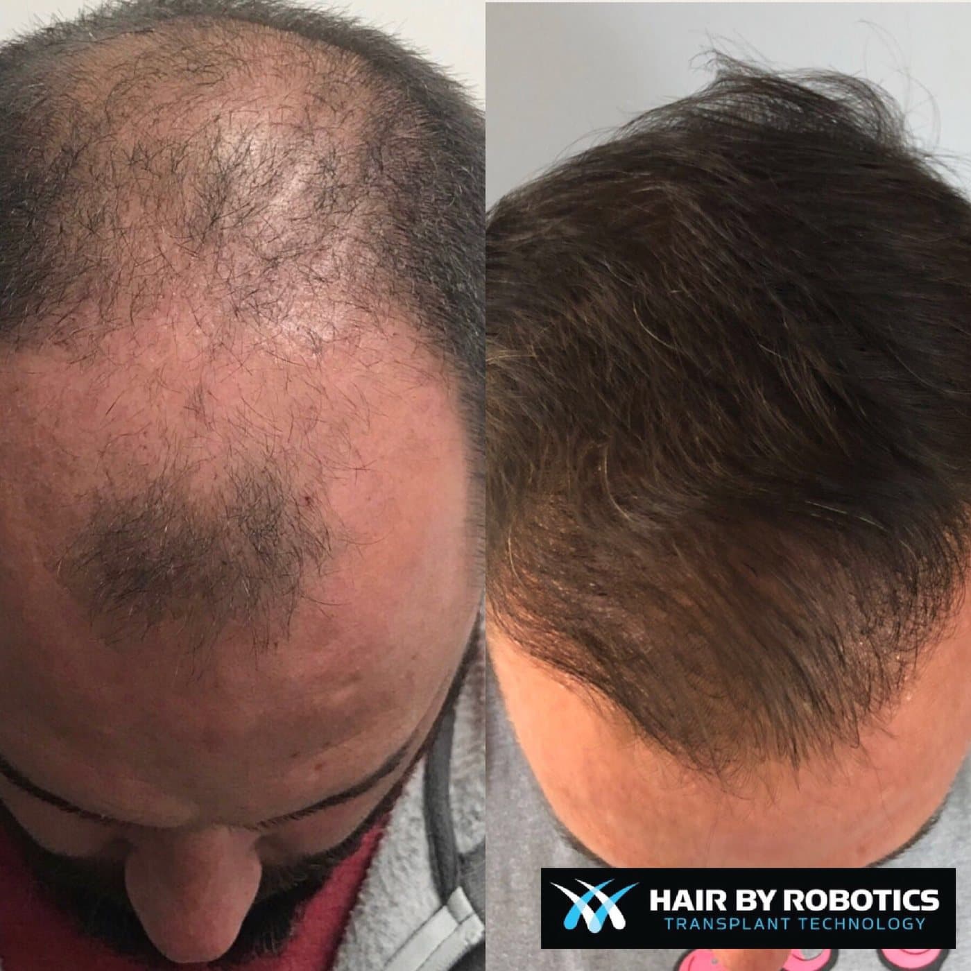 Before and after frontal hairline density restoration result